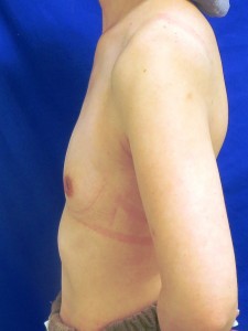 ③術前　左側面